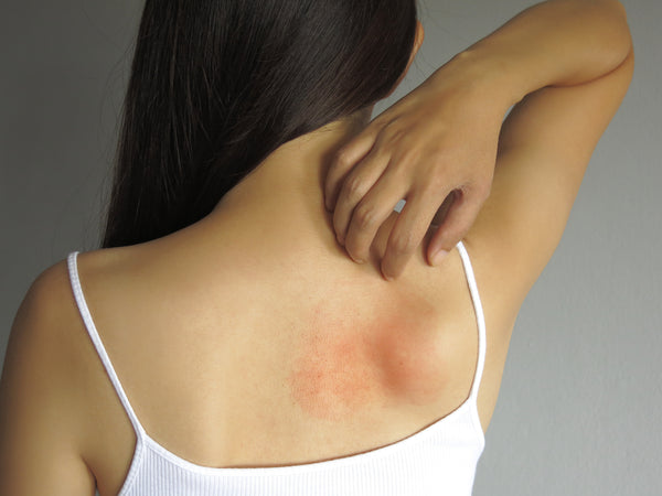 How To: Treat and Diminish Red & Sensitive Skin