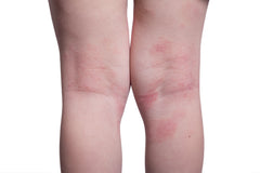 What is Eczema